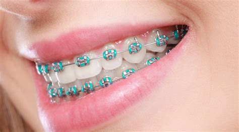 dental orthodontic metal brackets|traditional metal braces for adults.